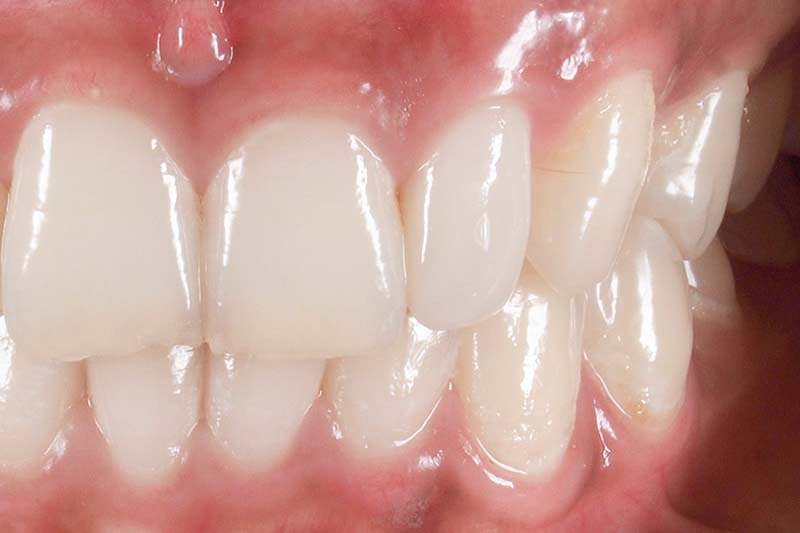 症例:治療後の歯