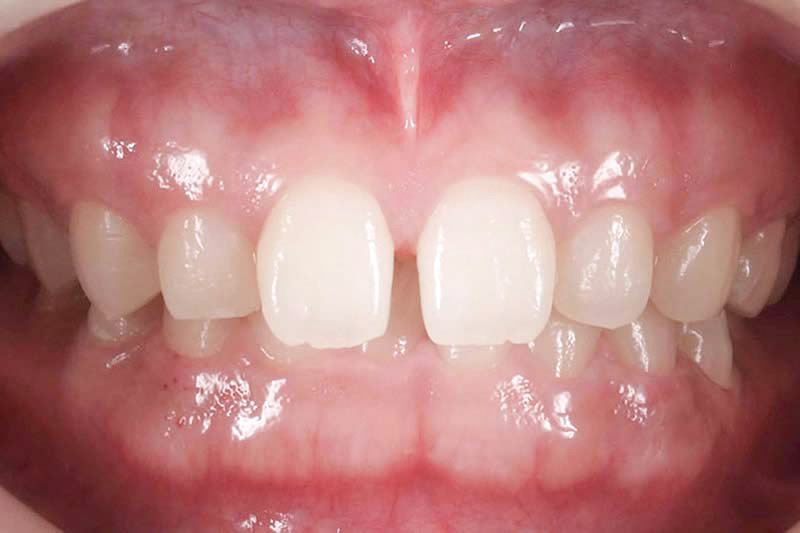 症例:歯の隙間