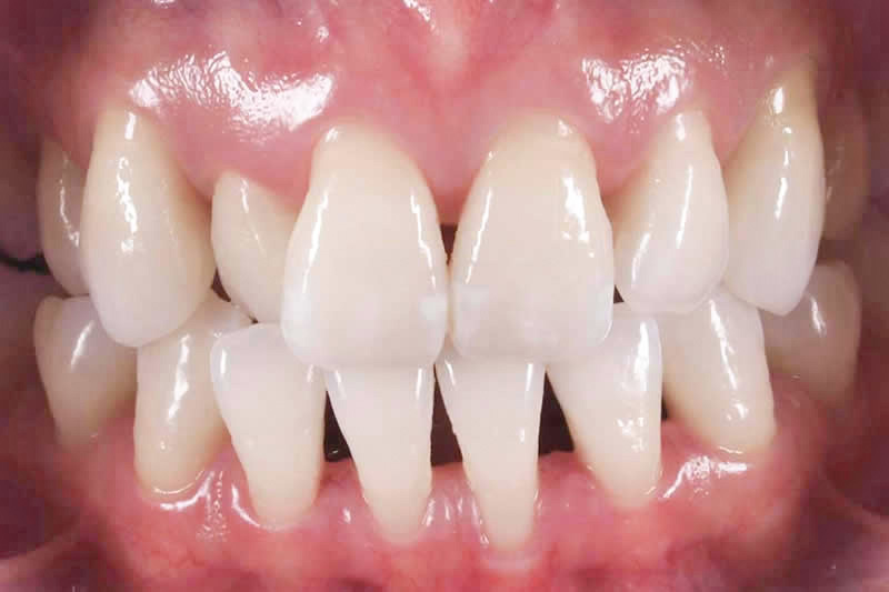 症例:治療前の歯が斜めになっている