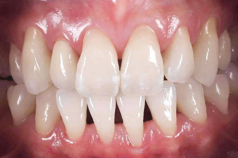 症例:治療後のジルコニア歯