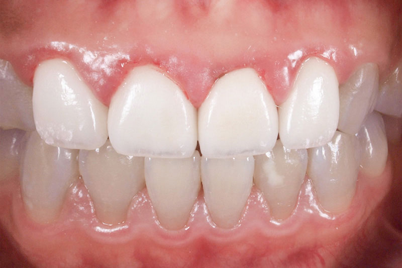 症例:治療前の歯茎が腫れ