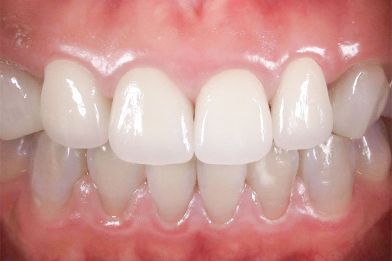 症例:治療後のジルコニア歯