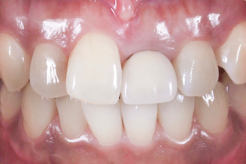 症例:治療前の歯根が破損している状態