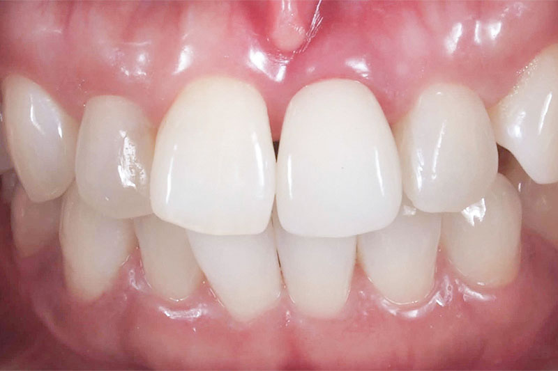 症例:治療後のインプラント治療によるジルコニア歯
