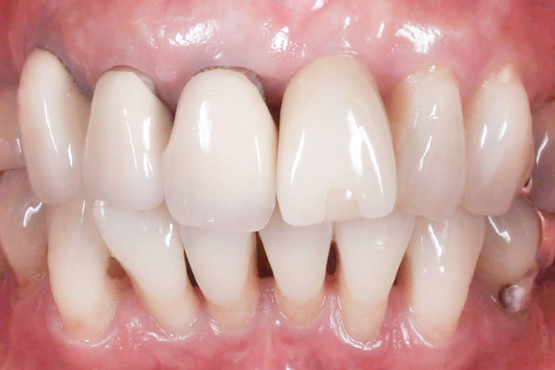 症例:治療前の歯の根元の黒ずみなど