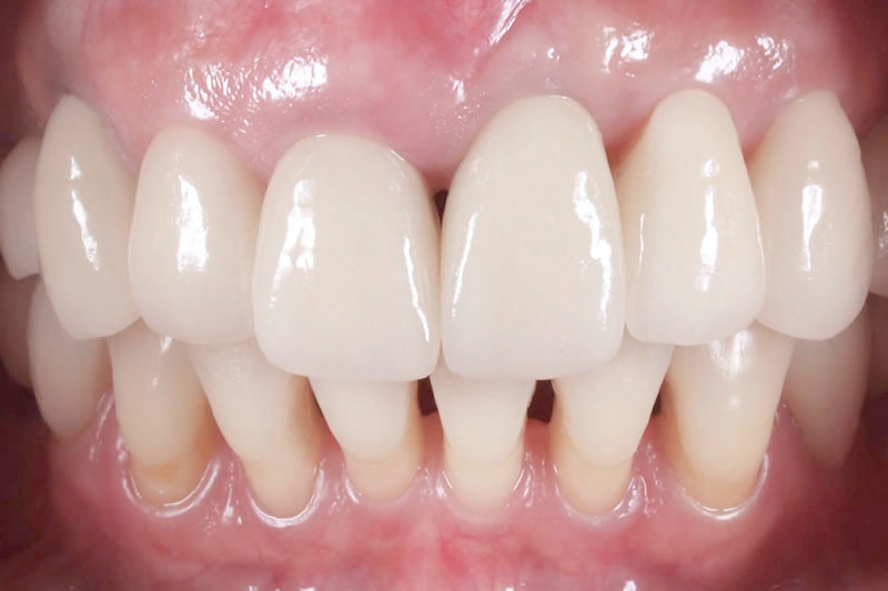 症例:治療後のインプラントによるジルコニア歯