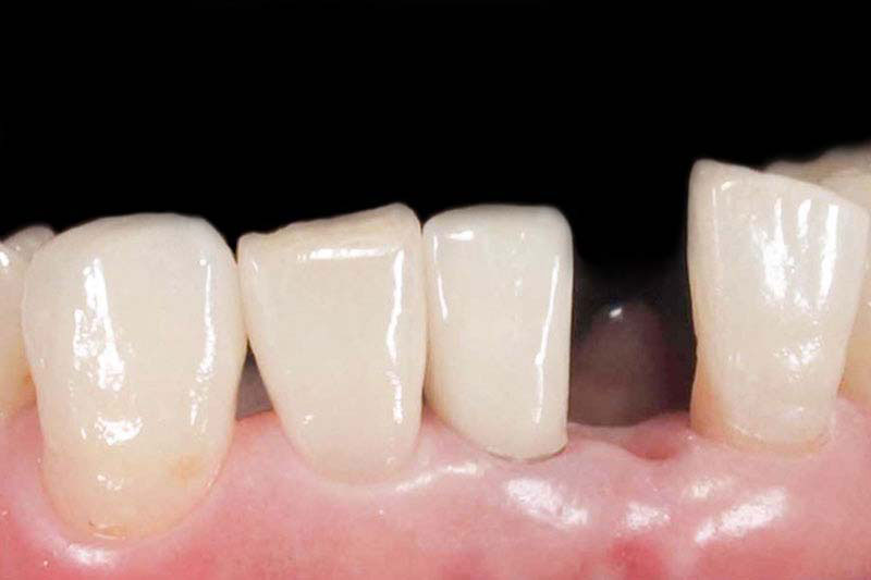 症例:治療前の歯がない状態