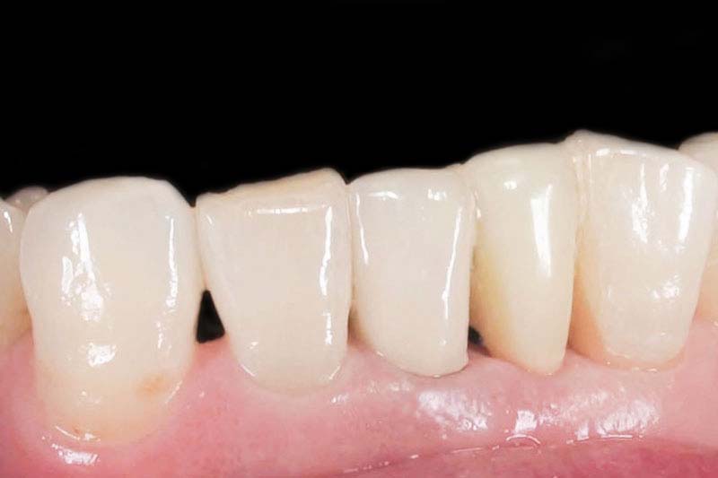 症例:治療後のジルコニア歯で修復した状態