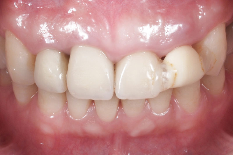 症例:治療前の歯がない状態